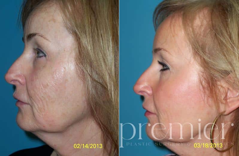Obagi Blue Peel