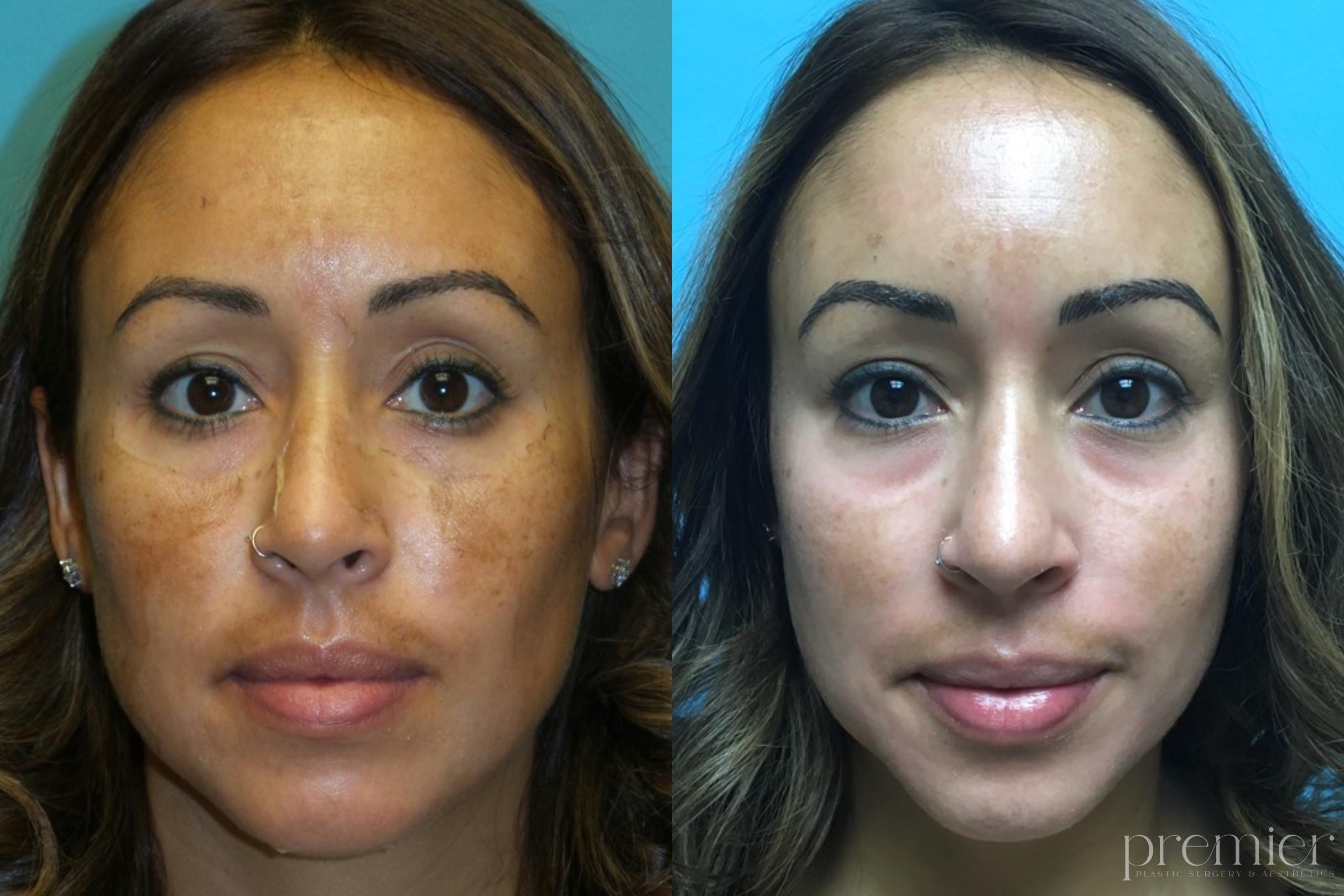 ZO 3 Step Peel 4